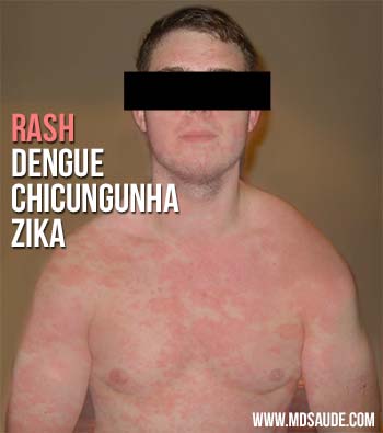 Rash dengue, Chicungunha e Zika