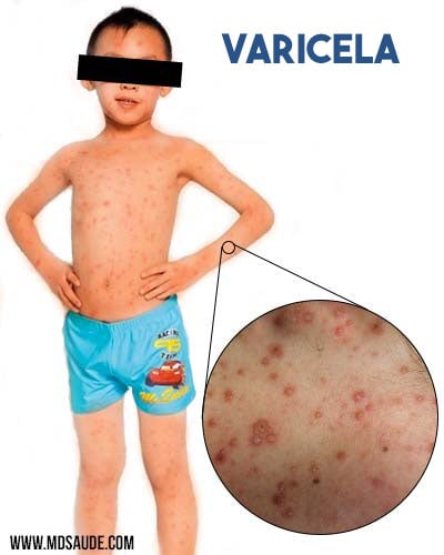 Rash de la varicela