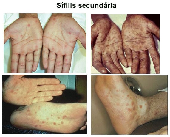 Sífilis secundaria