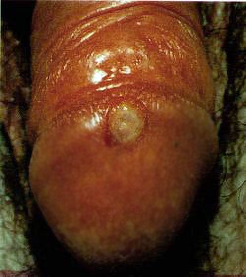 Syphilitic chancre