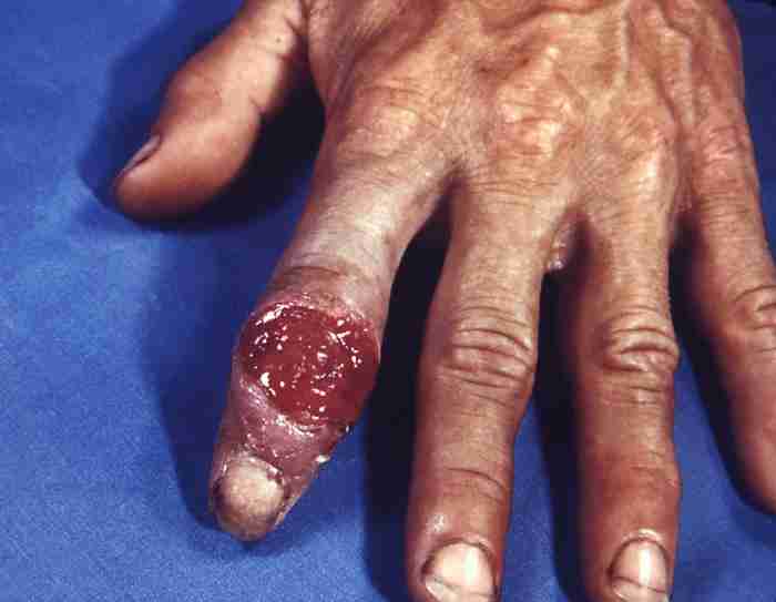 Syphilitic gumma on the hand - Tertiary syphilis