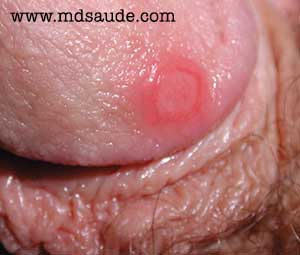 Úlcera genital - Sífilis primaria