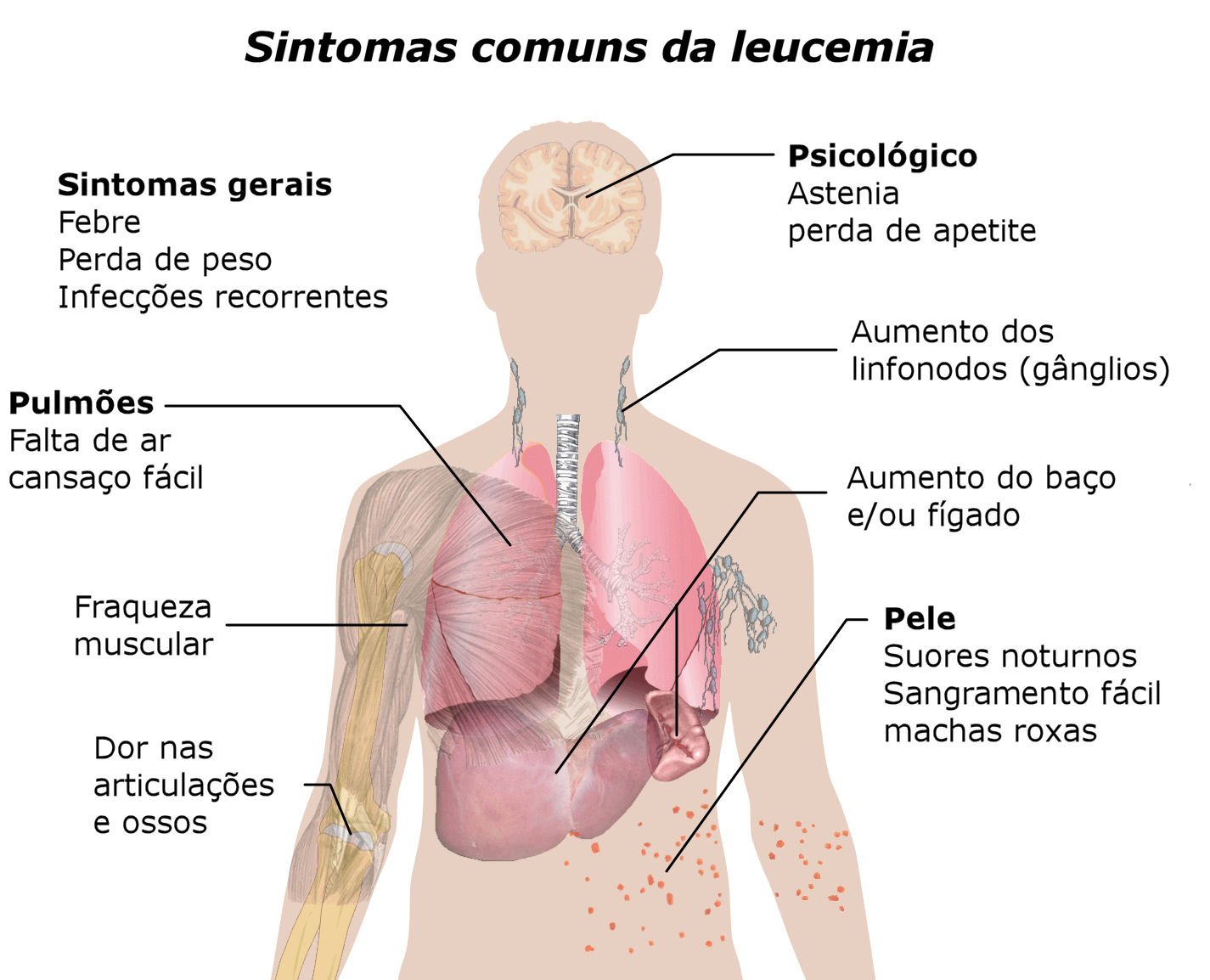 A Leucemia Pode se Espalhar para outros Órgãos?