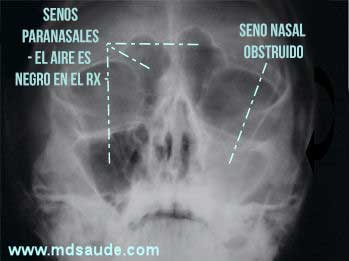 Radiografía de los senos paranasales