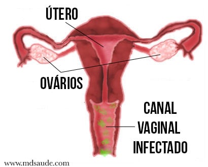 Vaginose