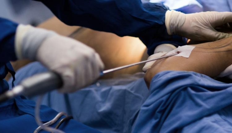 abdominoplastia