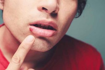 Queilitis signos y sintomas