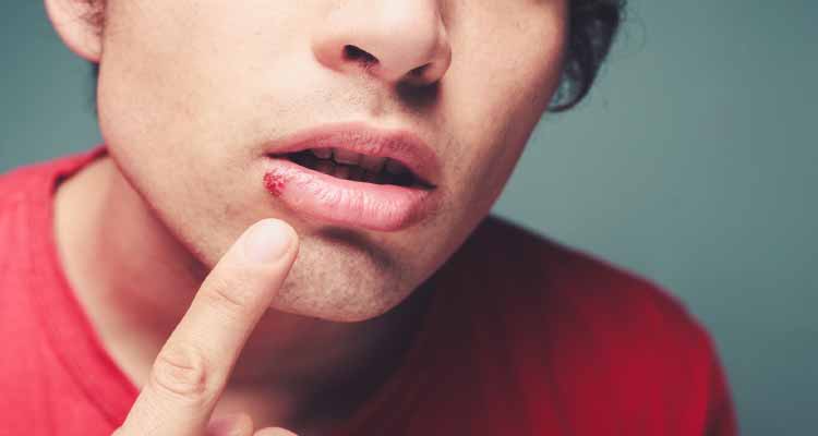 Aciclovir Zovirax Tratamiento Del Herpes Md Saude
