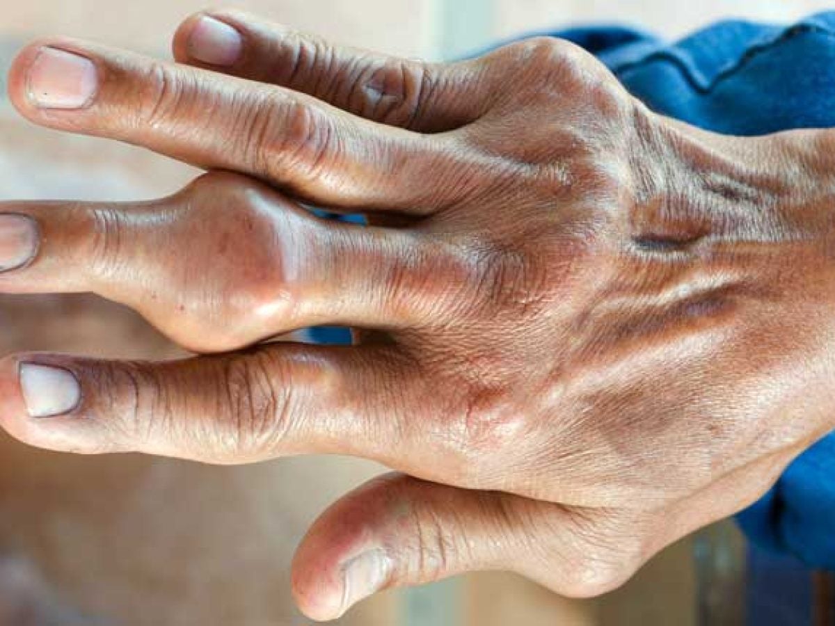 Ácido úrico: qué es, síntomas, riesgos y tratamiento