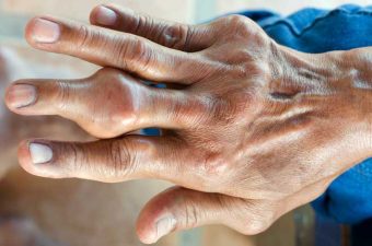 ÁCIDO URICO ALTO – ¿Qué causa y cuáles son los riesgos?