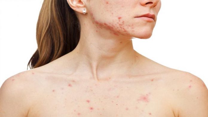 acne-ilustracao Acne