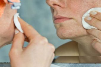 MEJORES TRATAMIENTOS DEL ACNÉ