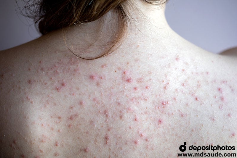 Acne no tronco