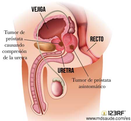 El tumor de próstata puede comprimir la uretra