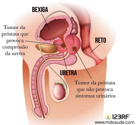 câncer de próstata sintomas portugues