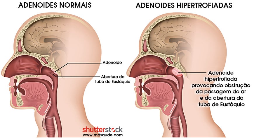 Adenoide