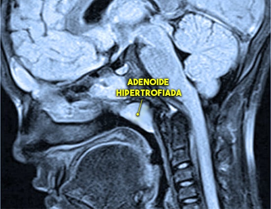 Adenoide hipertrofiada detectada em exame de ressonância magnética