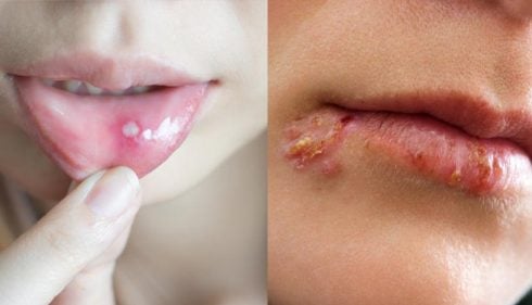 Diferencias entre afta y herpes labial (con imágenes)