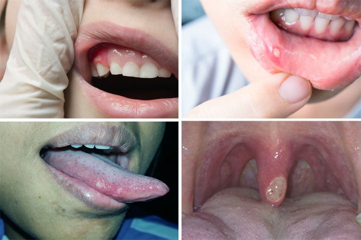 Imagens de aftas em diferentes locais da boca: língua, lábio, úvula e gengiva