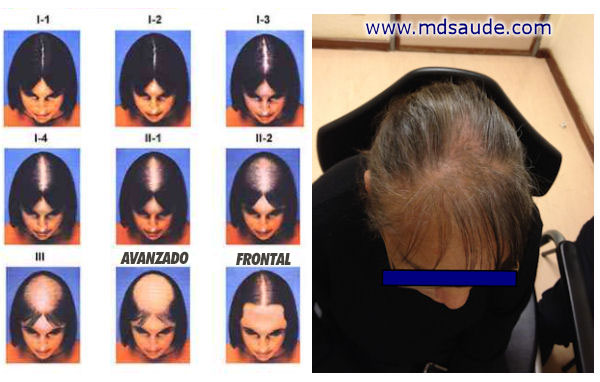 alopecia androgénica en las mujeres