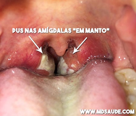 O que é a Mononucleose (doença do beijo)?