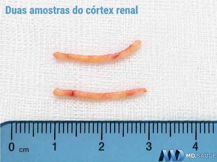 Duas amostras cilíndricas de tecido do córtex renal obtidas por biópsia, posicionadas sobre gaze branca ao lado de uma régua em centímetros.