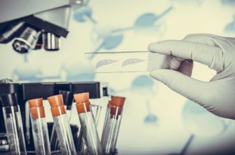 ANEMIA FALCIFORME – Traço, causas, sintomas e tratamento