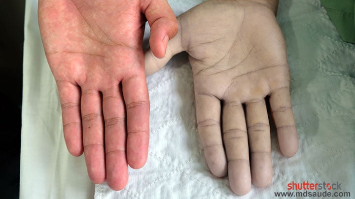 Imagem comparando a mão normal do médico, bem corada, com a mão pálida de um paciente com anemia.