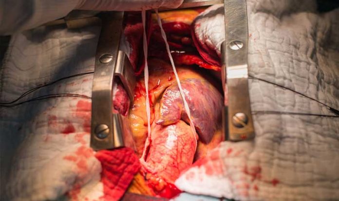aneurisma-abdominal-imagem