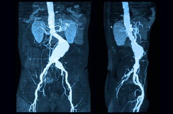 ANEURISMA DE LA AORTA ABDOMINAL – Causas, síntomas y tratamiento