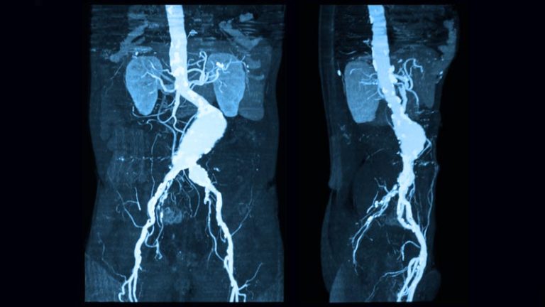 Aneurisma da aorta abdominal | Sintomas e tratamento