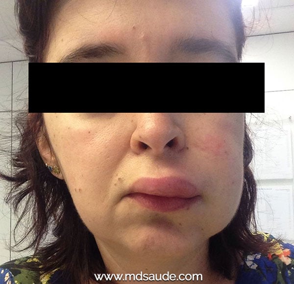 Angioedema por IECA