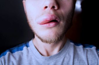 Angioedema