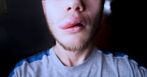 Angioedema