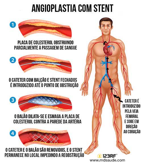 angiolpastia-com-stent