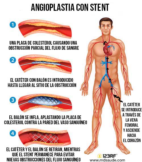 Como se hace un cateterismo cardiaco