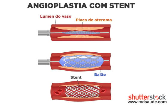 Angioplastia com stent da carótida