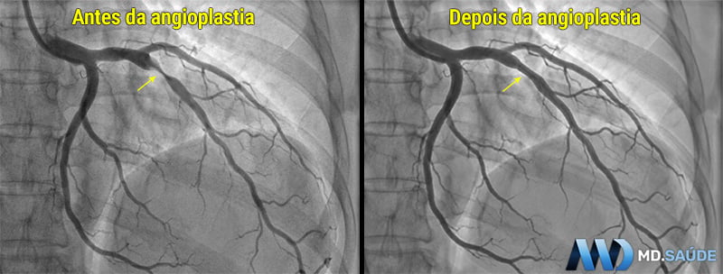 Comparação de coronariografias antes e após angioplastia da artéria descendente anterior (DA). Setas amarelas indicam o local da estenose no primeiro painel e o segmento tratado no segundo.