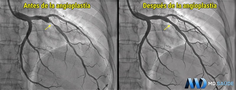 Comparación de coronariografías antes y después de una angioplastia de la arteria descendente anterior (DA). Las flechas amarillas indican el lugar de la estenosis en el primer panel y el segmento tratado en el segundo.
