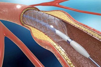 CATETERISMO CARDÍACO – Angioplastia com Stent