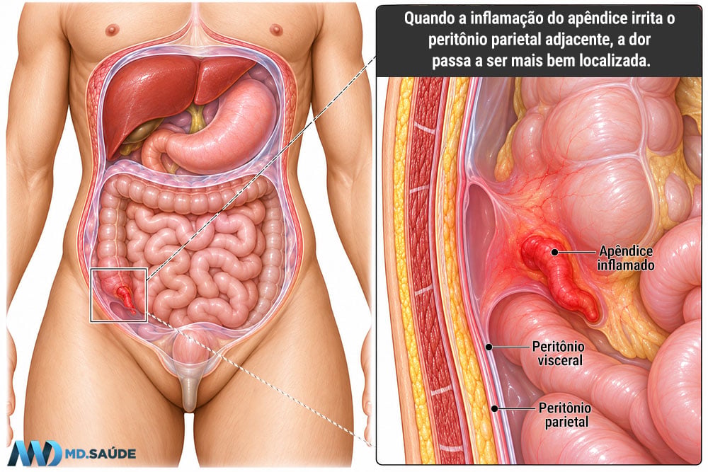 Inflamação localizada do peritônio pela apendicite