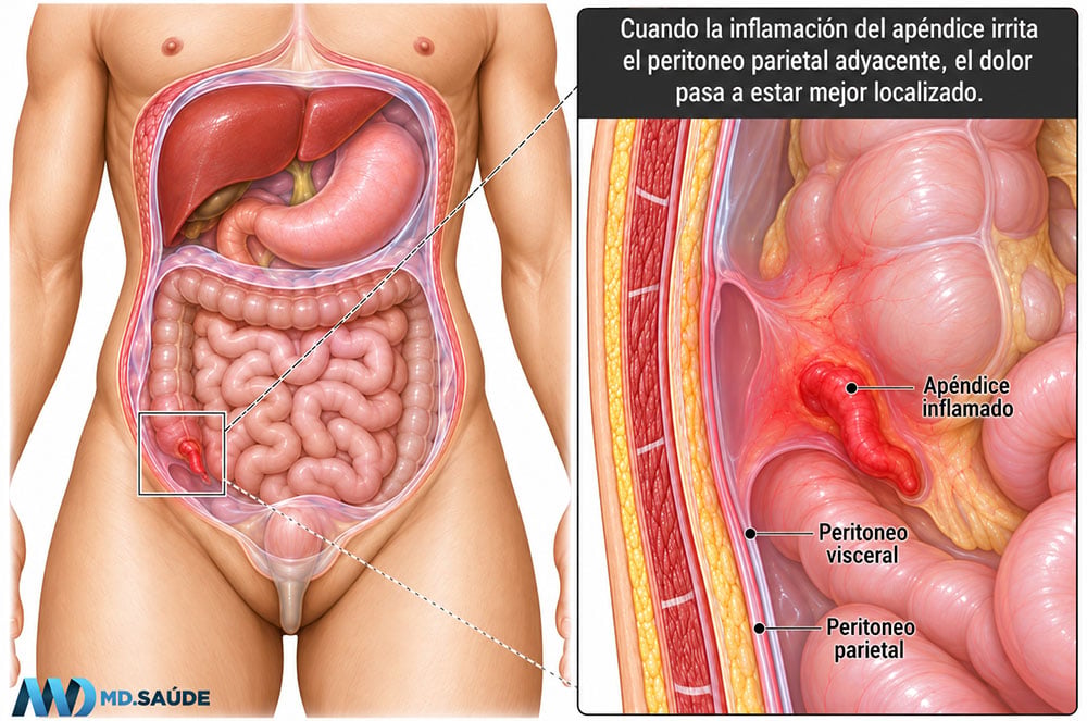 Inflamación localizada del peritoneo por la apendicitis
