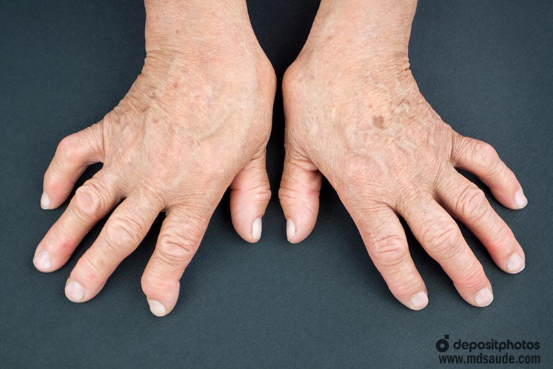 Desvio ulnar dos dedos na artrite reumatoide