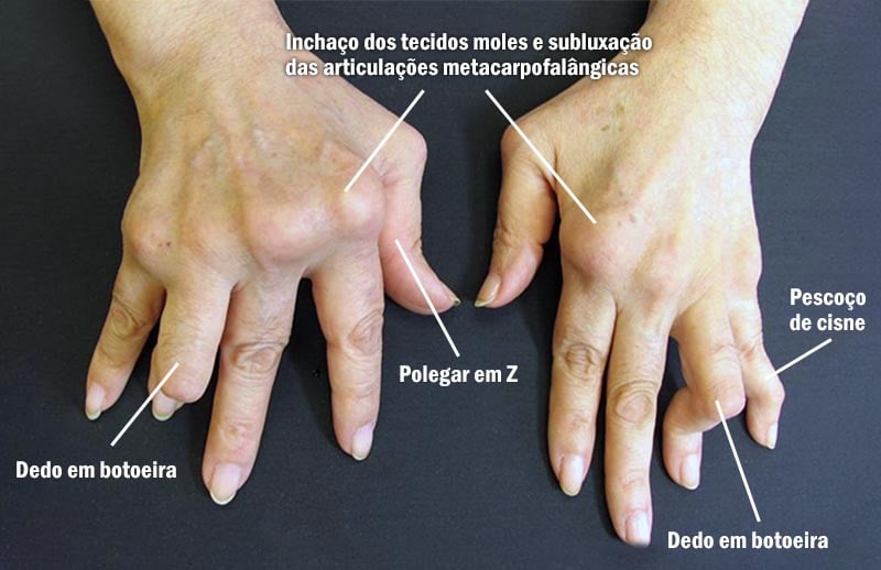 Deformidades da artrite reumatoide
