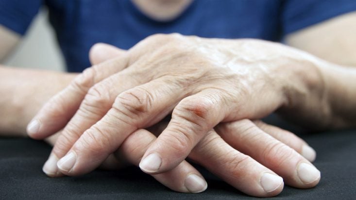 Artritis reumatoide: síntomas, criterios y tratamiento