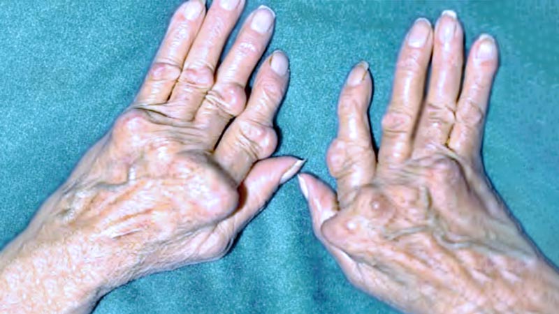 Deformidades nas mãos e nódulos subcutâneos