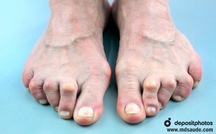 Deformidade nos pés
