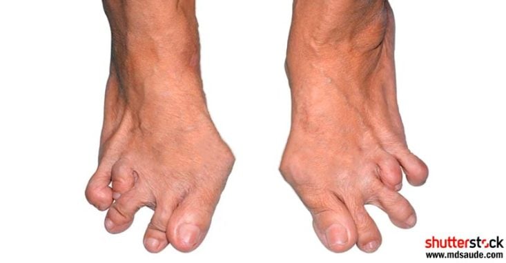 Deformidade avançada nos pés