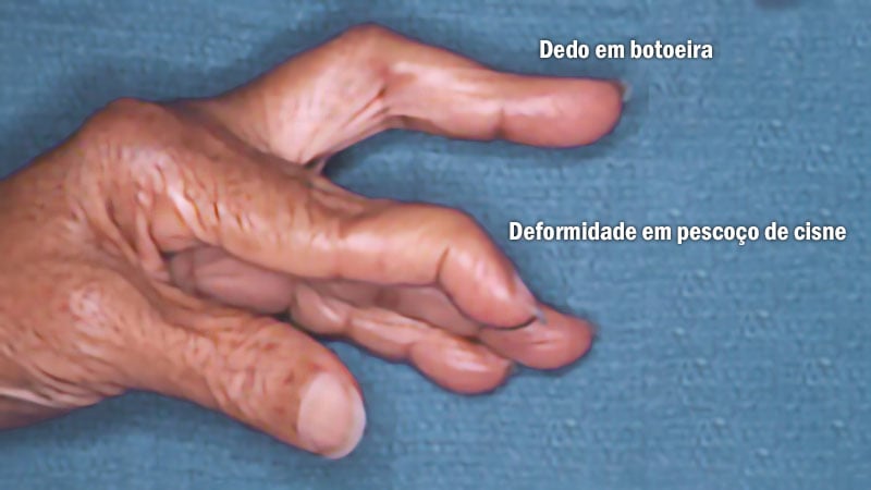 Dedo em botoeira e deformidade em pescoço de cisne
