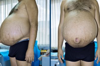 ASCITIS – Síntomas, Causas y Tratamiento